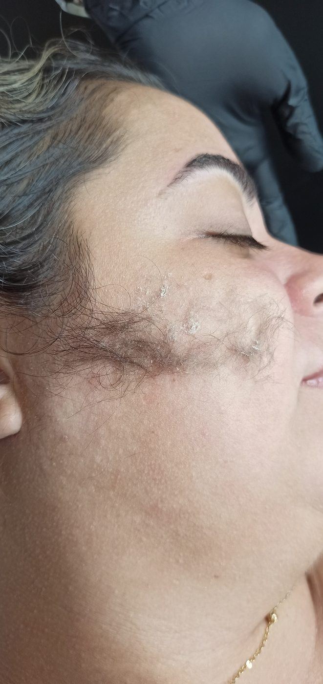 Dermaplaning facial