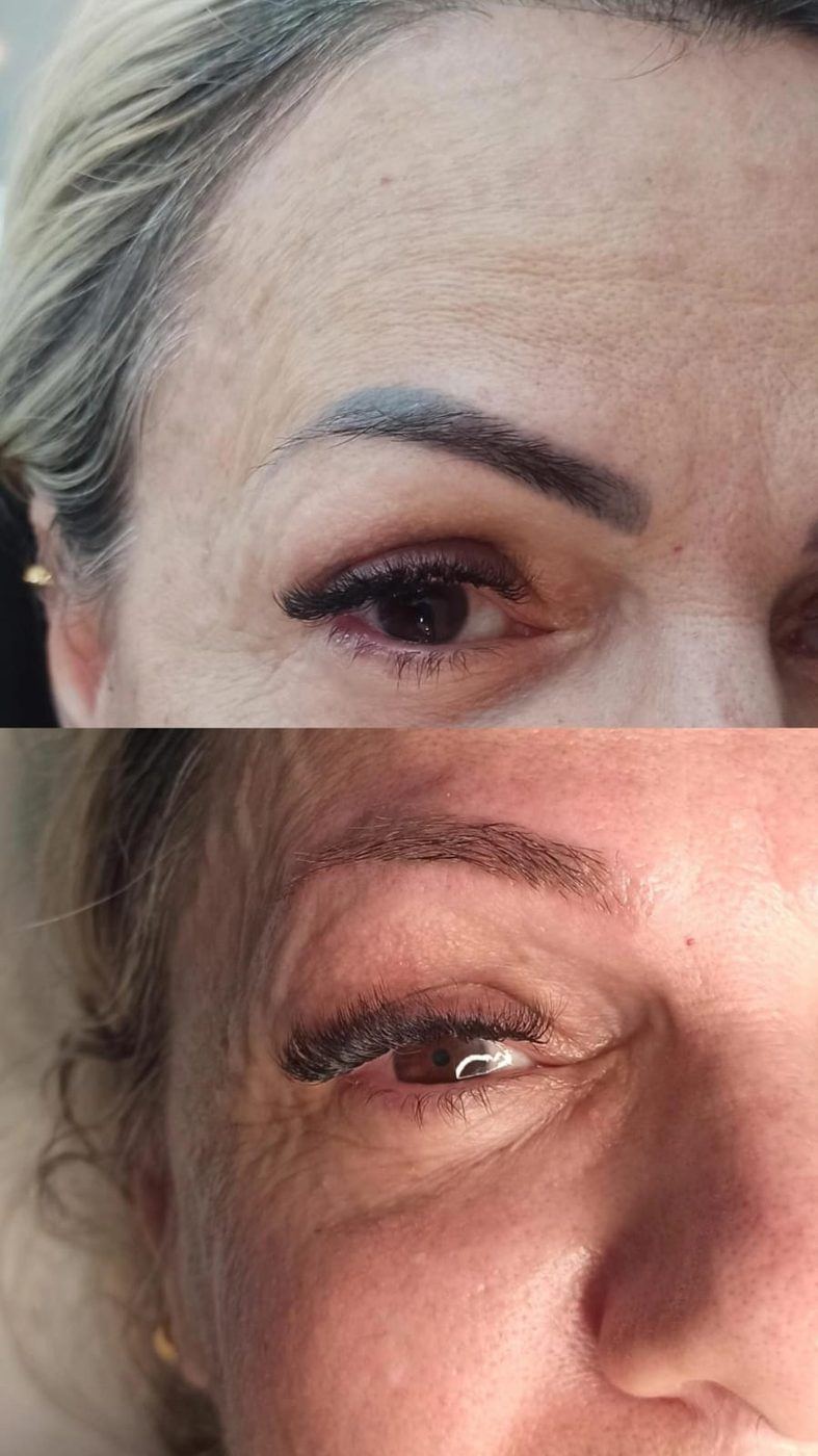 Remoção a laser de micropigmentação